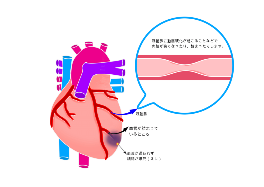 心筋梗塞の原因と予防について｜健康・医療・美容に関する情報配信、ライフドア